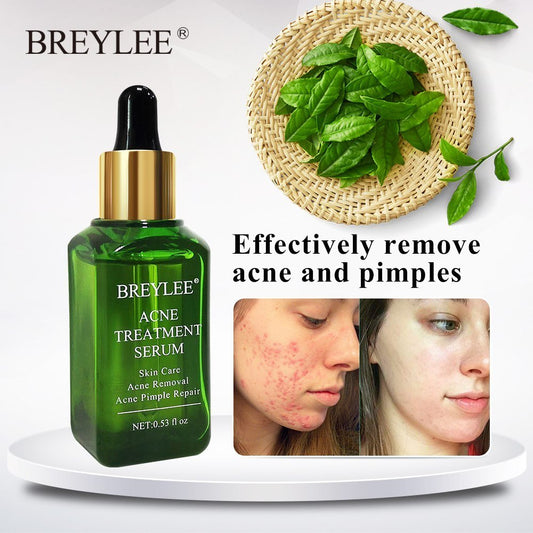 BREYLEE Acne Treatment Serum - Rarvelle