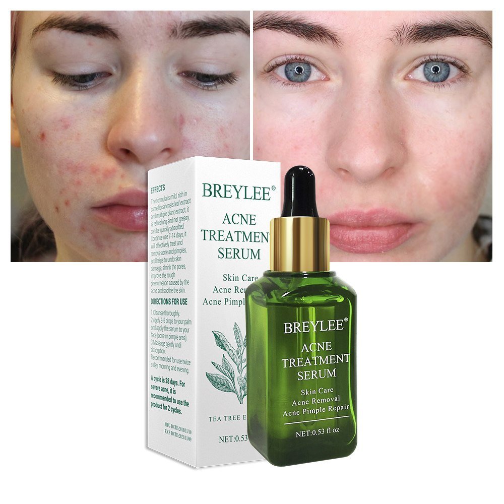 BREYLEE Acne Treatment Serum - Rarvelle