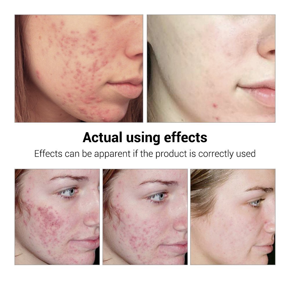 BREYLEE Acne Treatment Serum - Rarvelle