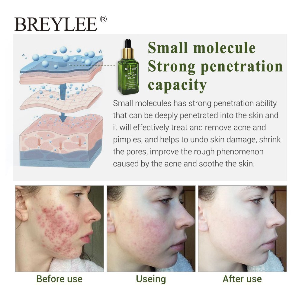 BREYLEE Acne Treatment Serum - Rarvelle