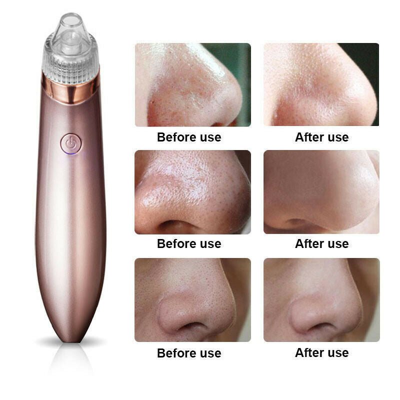 Smart Blackhead Vacuum Pore Cleaner - Rarvelle