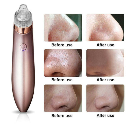 Smart Blackhead Vacuum Pore Cleaner - Rarvelle